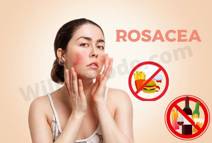 Avoid dainty food if you have Rosacea Skin