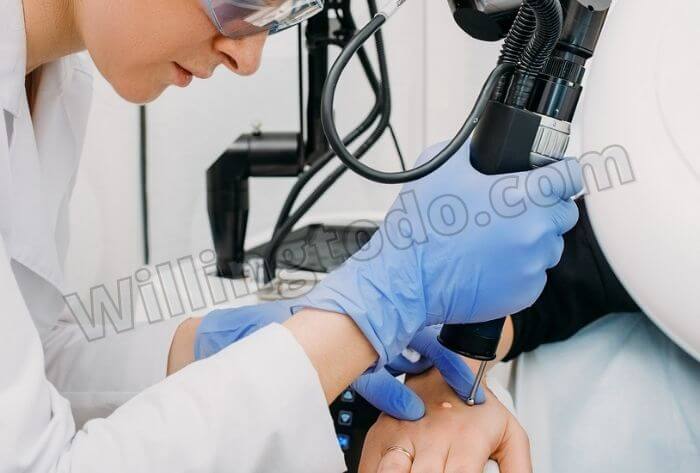 Cryotherapy to get rid of a verruca