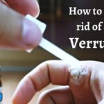 How to get rid of a Verruca