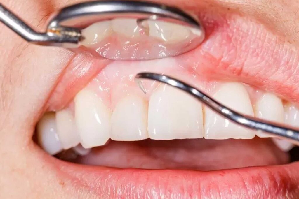 Treating Cuts on Gums