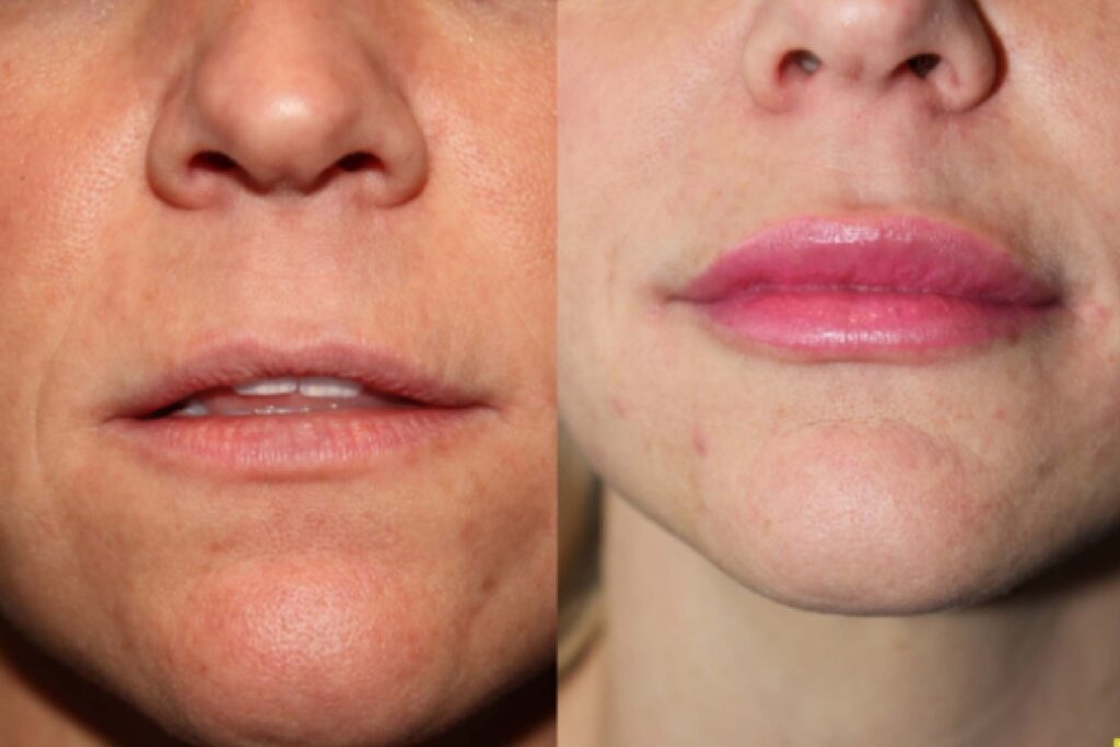 Differnce between Non-Surgical Solutions for Uneven Lips